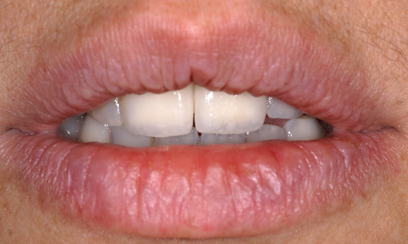 augmentation osseuse