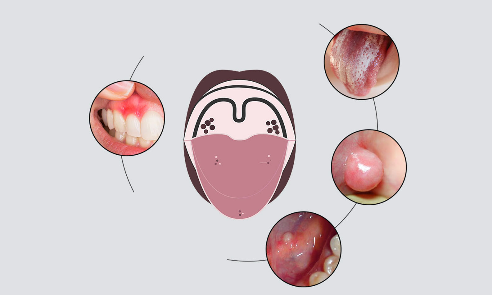 Maladies de la bouche