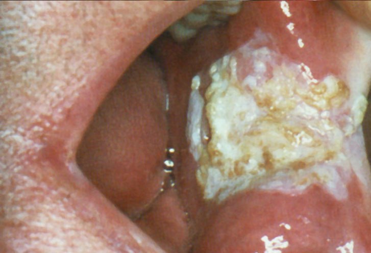 Papillomatose orale floride de la région rétrocommissurale