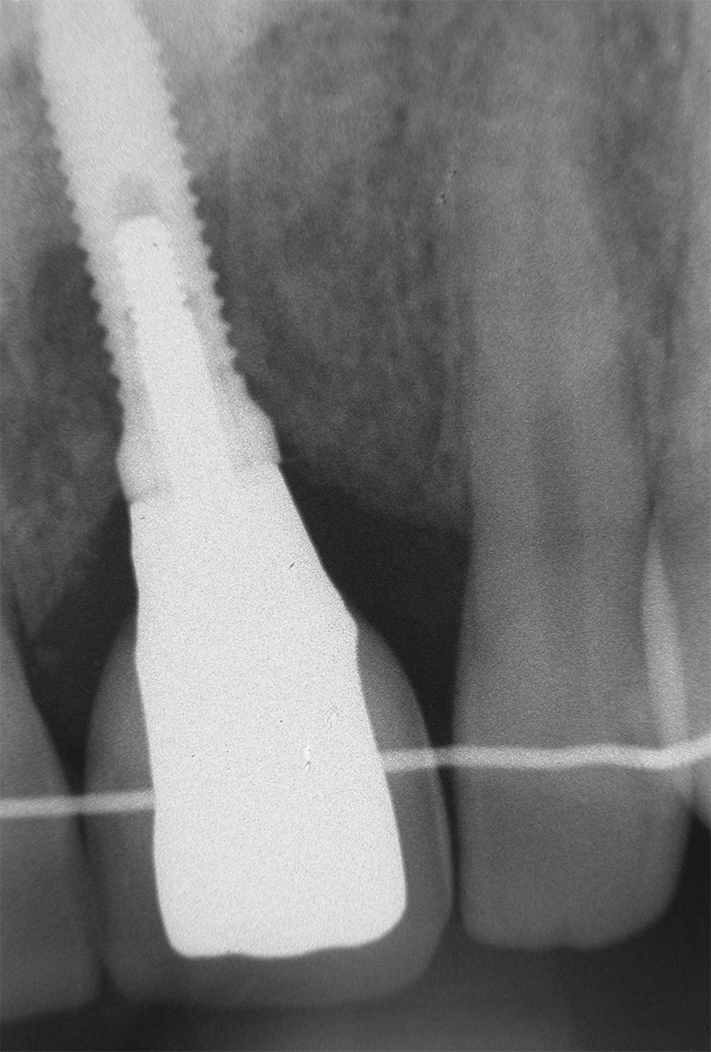 Radiographie rétroalvéolaire