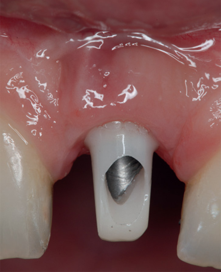pilier zircone