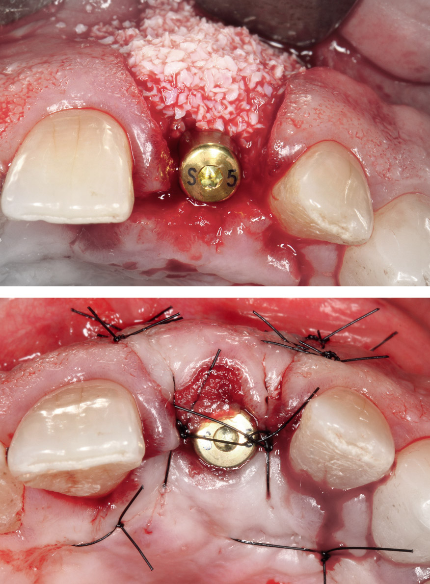 Augmentation osseuse