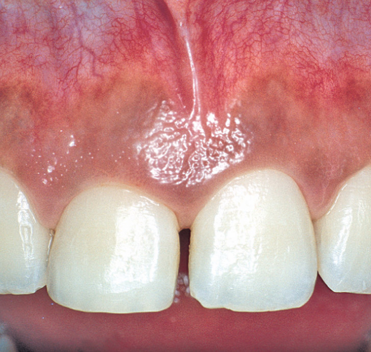diagnostic lésion parodontale dent 11