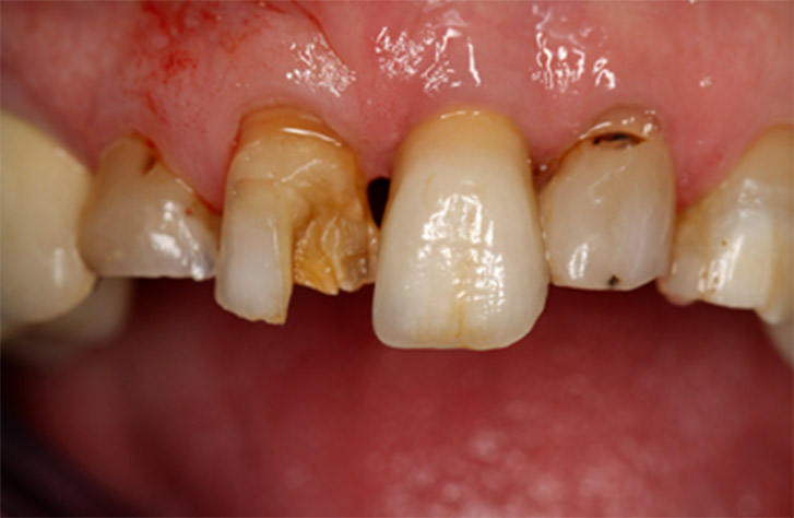 halitose caries dentaires