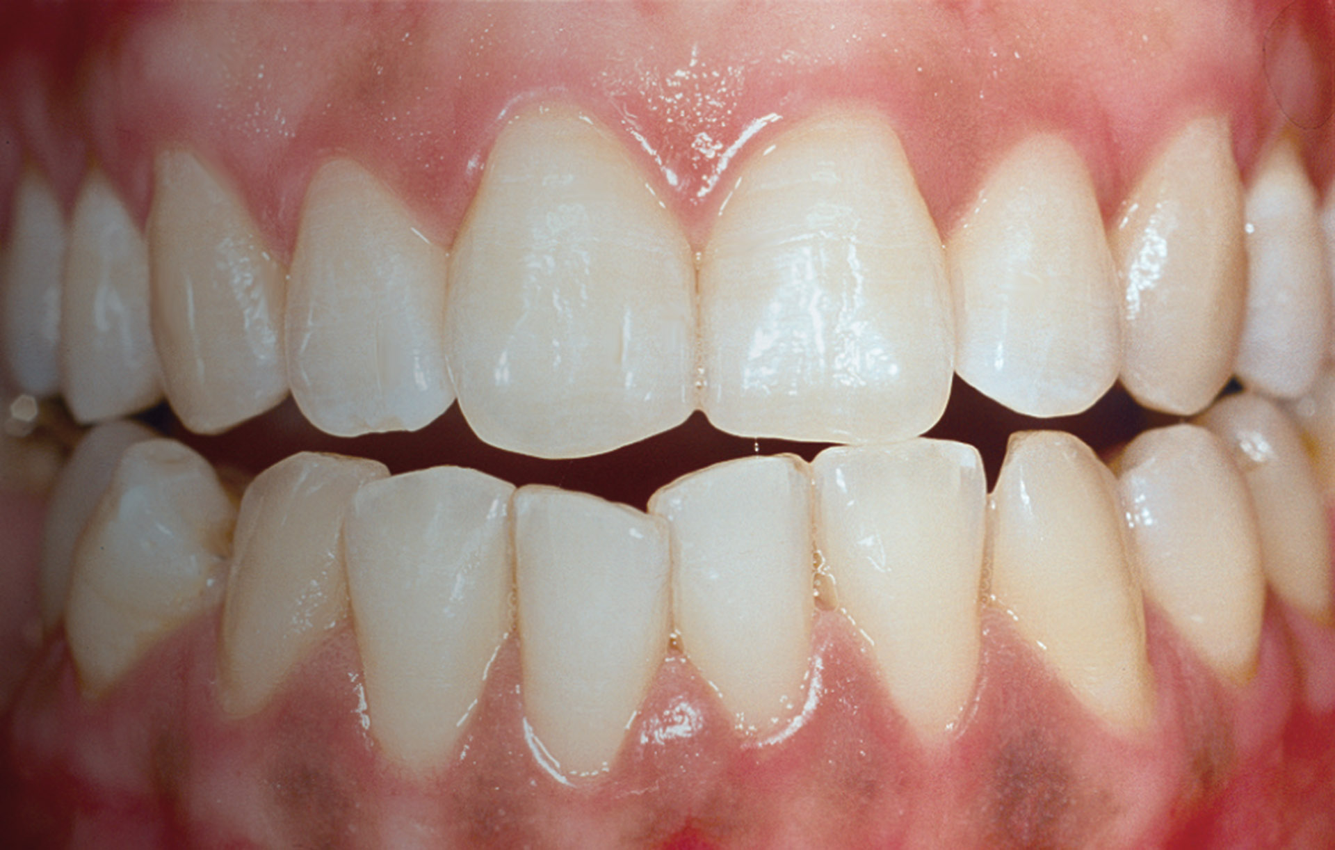 malocclusion occlusion dentaire