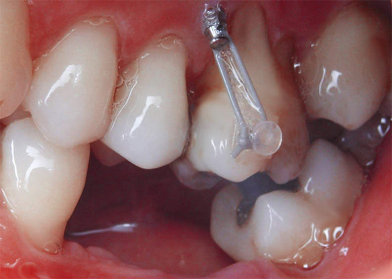 mini-implants ligature élastique