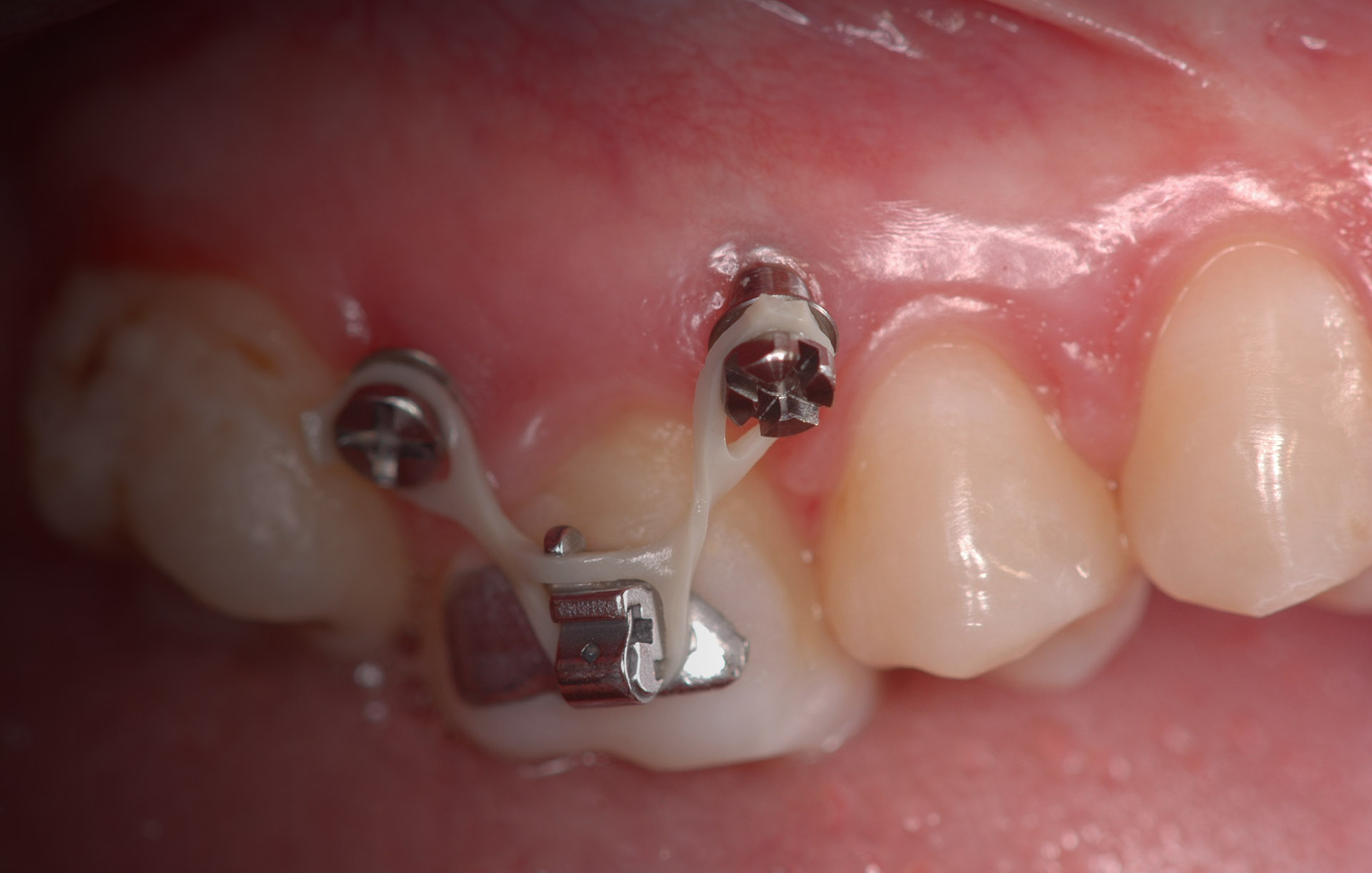 mini implants minivis orthodontie