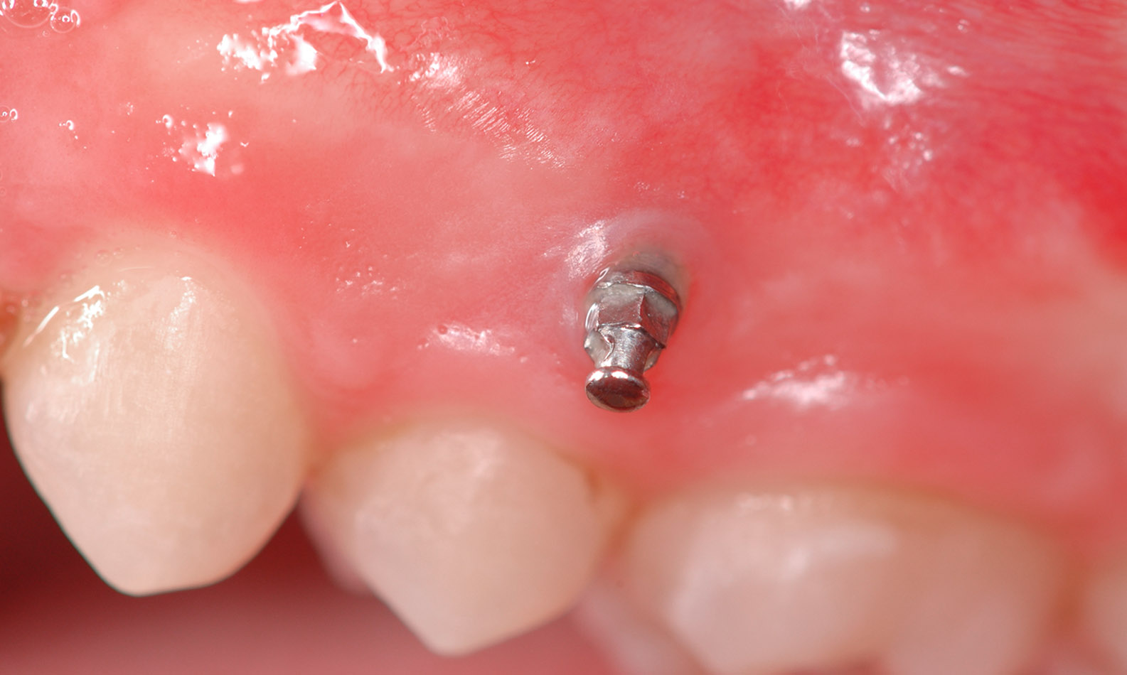 minivis orthodontique