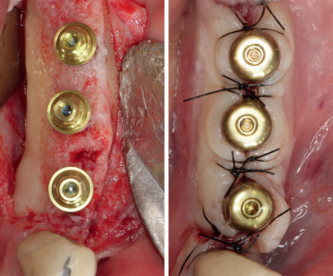 piliers implants Seven Plus Mis