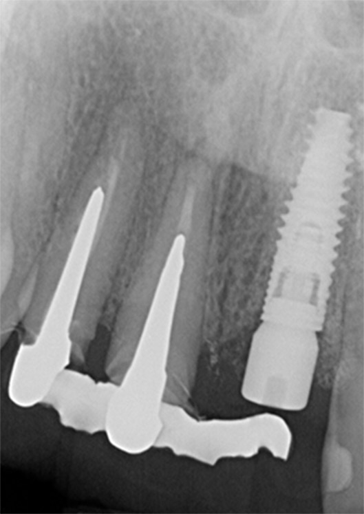 Radiographie de contrôle