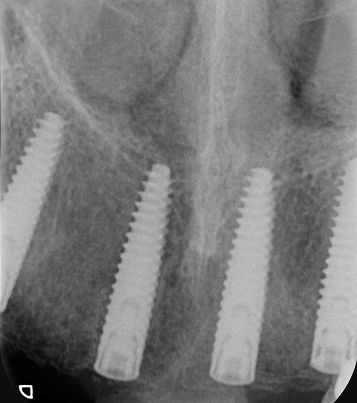 Radiographie de contrôle IAO