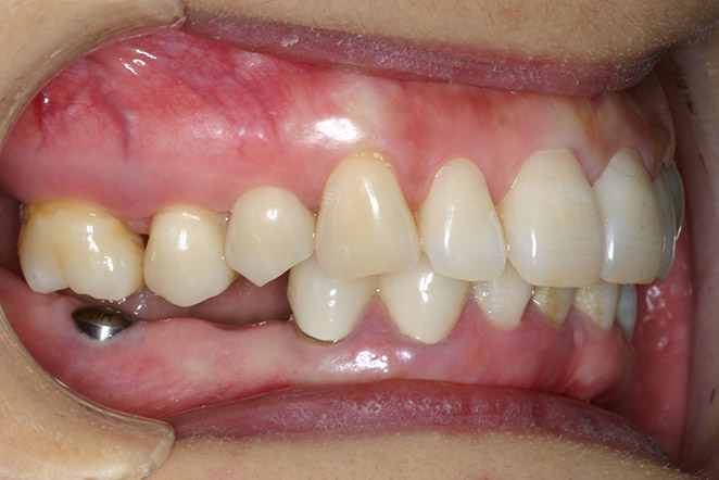 surocclusion implants dentaires