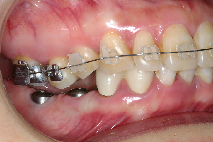 surocclusion orthodontie implants dentaires