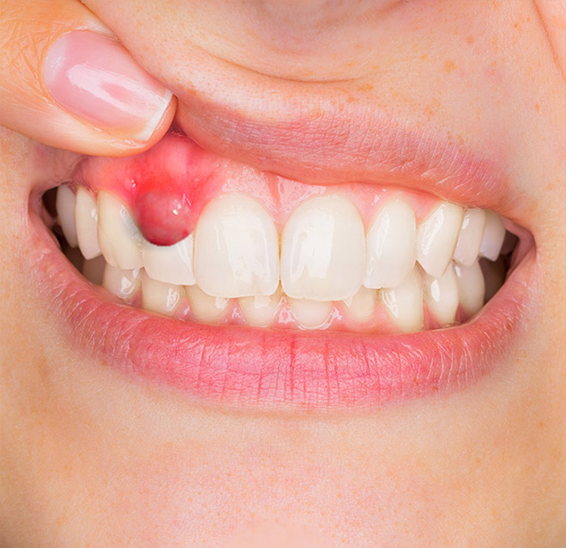 pathologie de la bouche