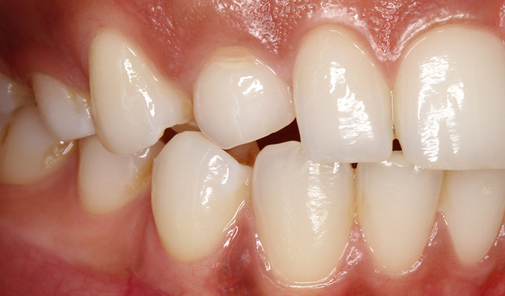 extraction implantation immédiate