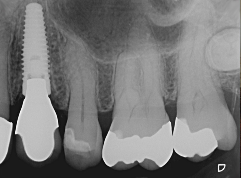 radiographie niveau osseux