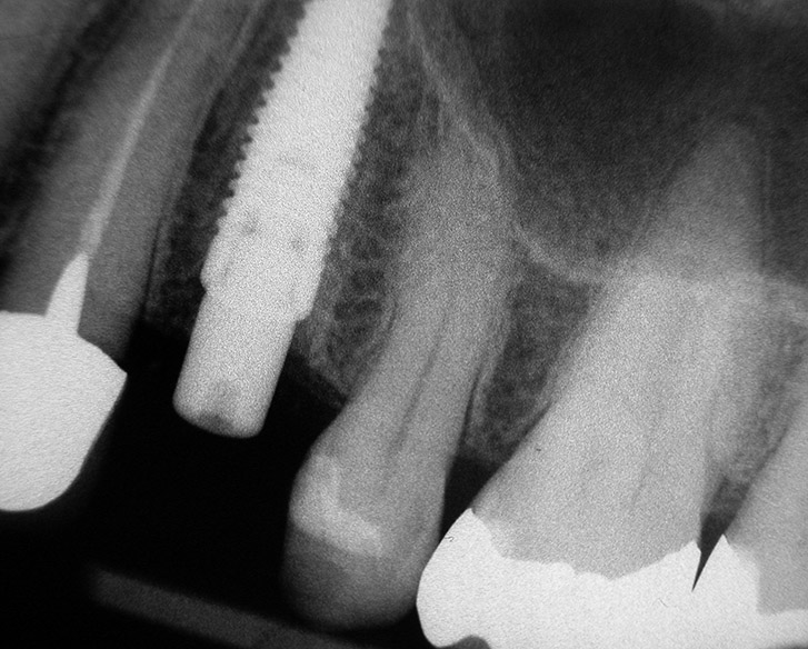 radiographie postopératoire MCI